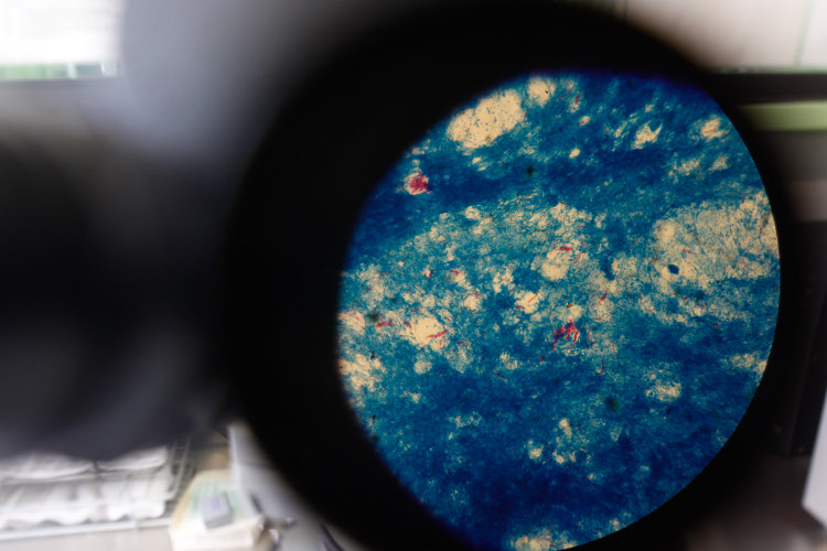 En la imagen se observa a través del microscopio la muestra de tejido enfermo con tuberculosis.