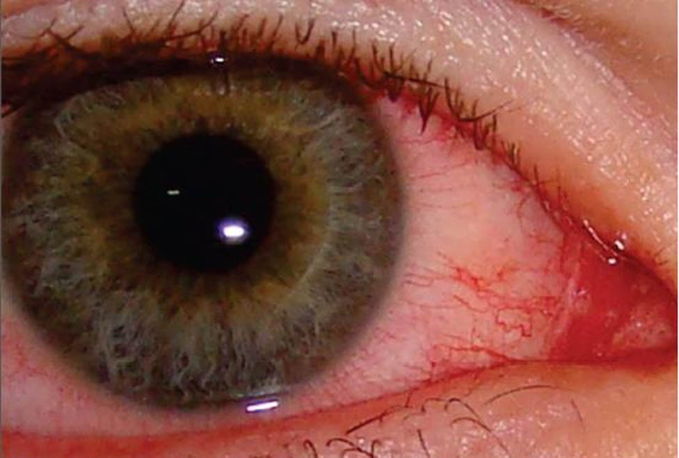 En Jalisco anualmente se registran entre 15 mil y 20 mil casos de conjuntivitis aguda hemorrágica
