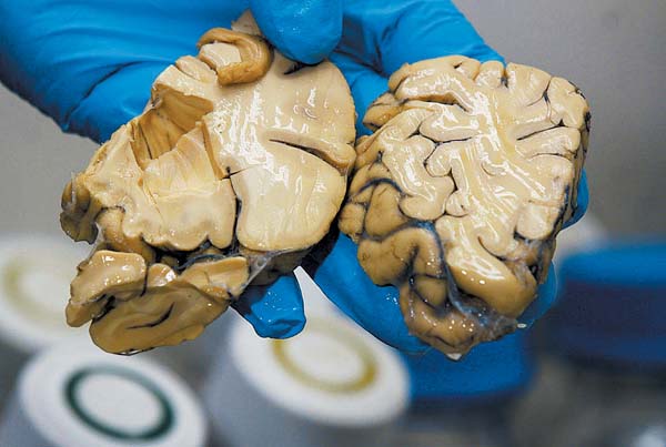 Algunos tienen rastros de enfermedades neurodegenerativas, otros pertenecieron a personas sanas.