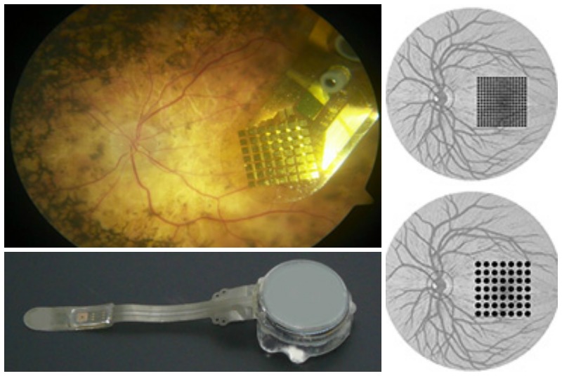 Una parte del chip se instala en la superficie del globo ocular mientras que la segunda se coloca en el nervio óptico.