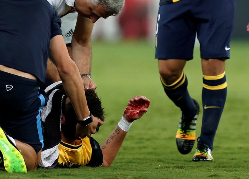 Mario Mandzukic fracturado