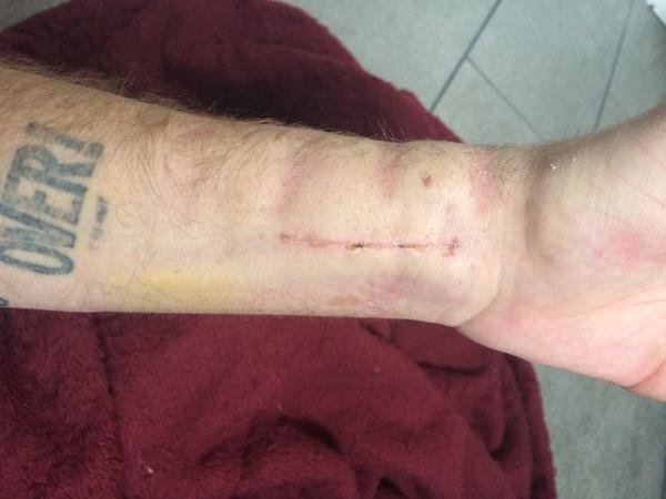 La muñeca fracturada de Drake Bell. 