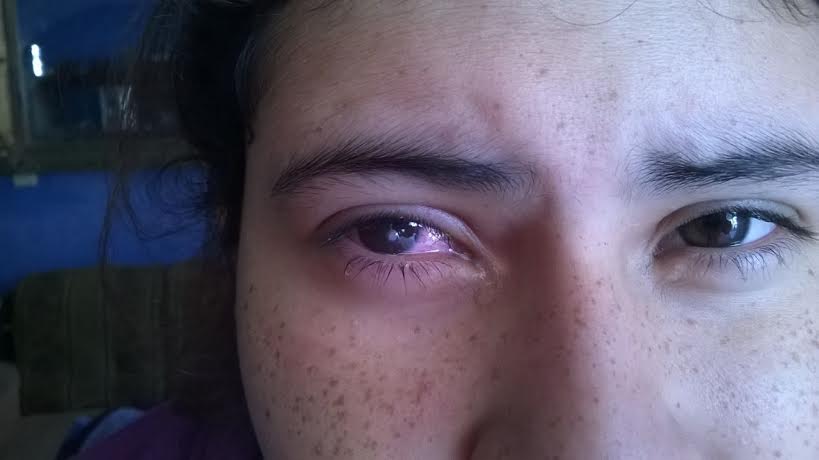 La infección creció por el mal diagnostico.