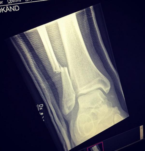 La banda Foo Fighters publicó la radiografia de la pierna de Dave Grohl.