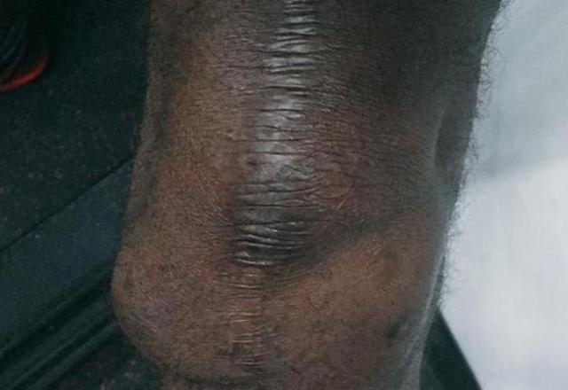 Así es el actual estado de la rodilla de LeCharles Bentley