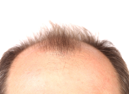 Científicos están probando un medicamento que haría crecer el cabello en menos de un mes. 