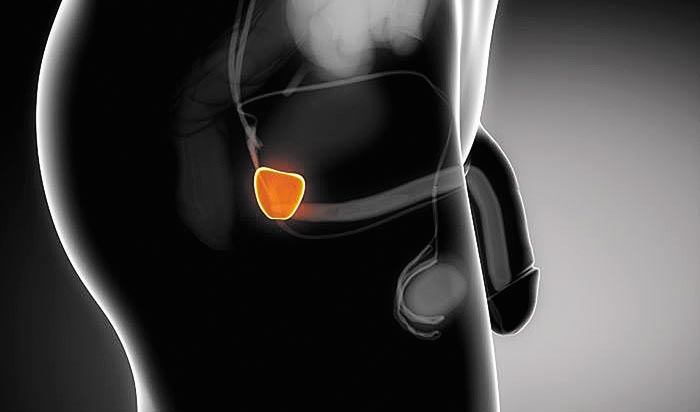 No se debe esperar a que los síntomas del cáncer aparezcan, pues se presentan hasta que está avanzado.