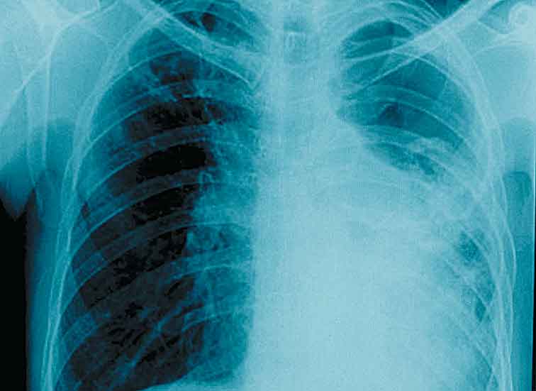 La neoplasia es asintomática en sus primeras etapas.
