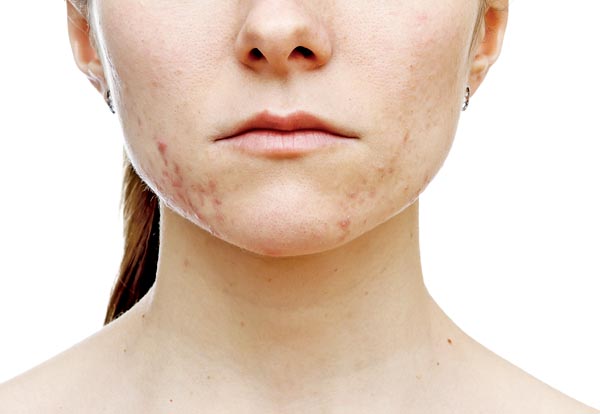 El tratamiento que ofrecerá el dermatólogo dependerá del tipo de acné que tenga el paciente.