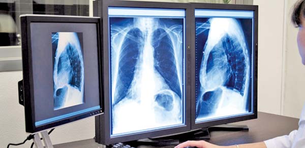 En los próximos 20 años se diagnosticarán 11 mil casos de cáncer de púlmon en México.
