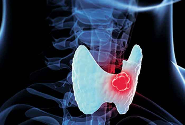 Cáncer de tiroides.