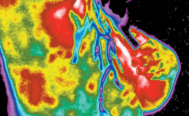 A través de la temperatura corporal se puede obtener un indicador del padecimiento. 