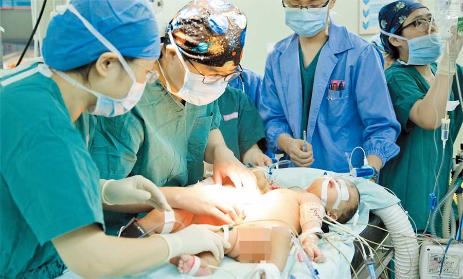 Con la ayuda de la tecnología de imagen tridimensional, las niñas fueron separadas.