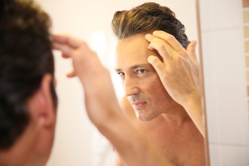En varones, la pérdida de cabello se llama 'alopecia androgenética'.