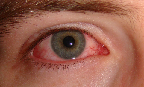 Si sientes ardor y tienes los ojos enrojecidos, evita frotarlos, pues podrías aumentar la intensidad de los síntomas.