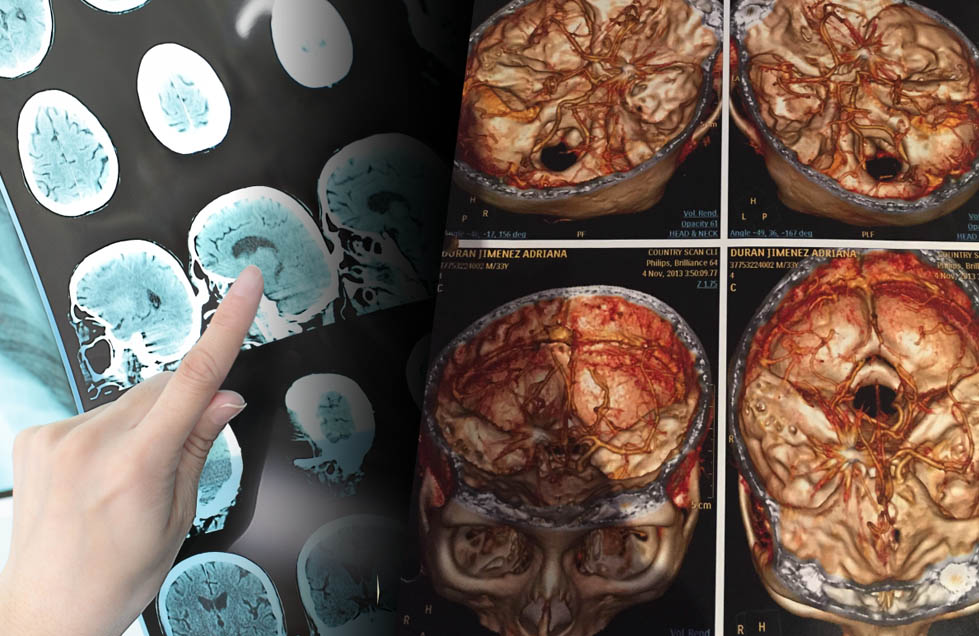 La fibrilación auricular puede conducir a un infarto cerebral, a un ataque al corazón o fallo cardíaco.
