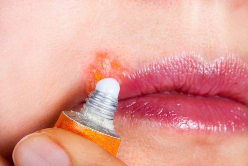 El herpes labial se presenta al debilitarse el sistema inmunológico.