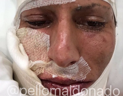 Tras accidente con pirotecnia, así luce el rostro de Jürgen Damm