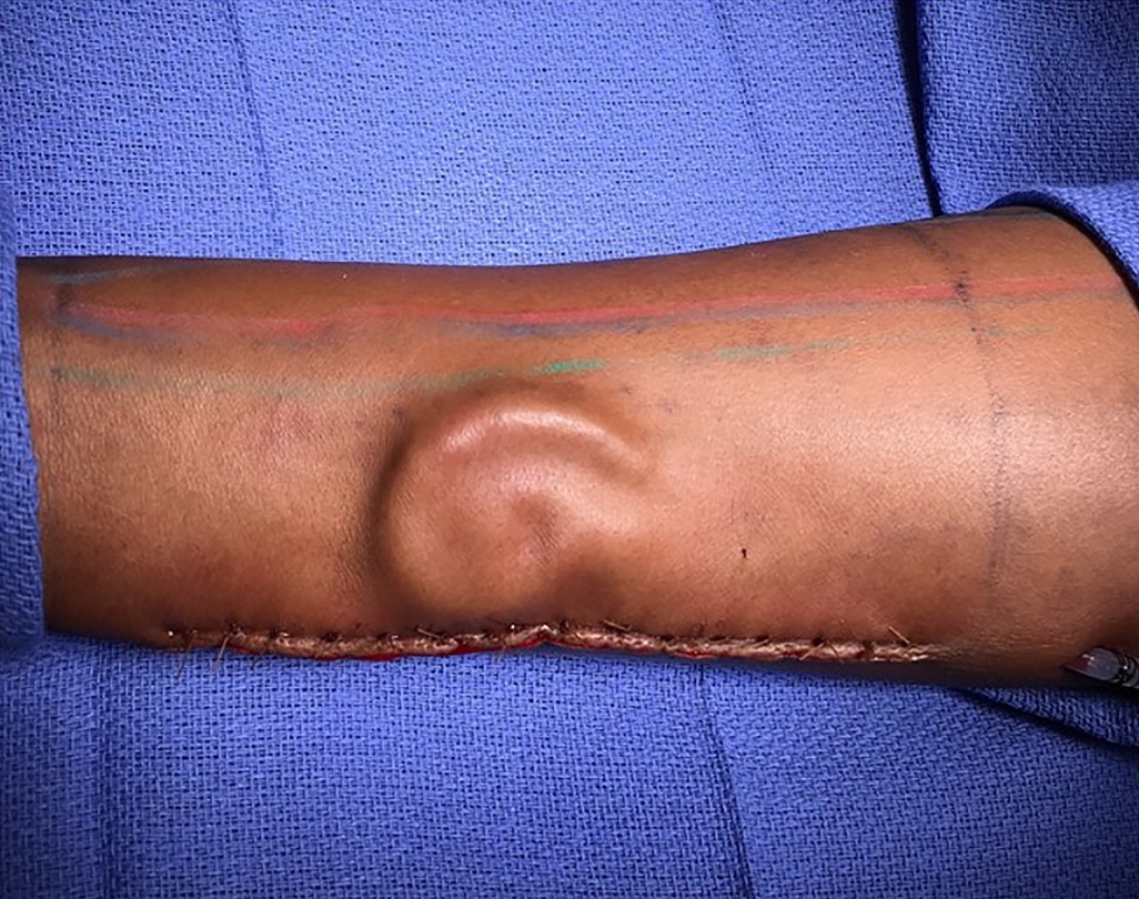 El cartílago fue tomado de las costillas y colocado debajo de su brazo para permitir que se forme una nueva oreja. (Foto: army.mil)