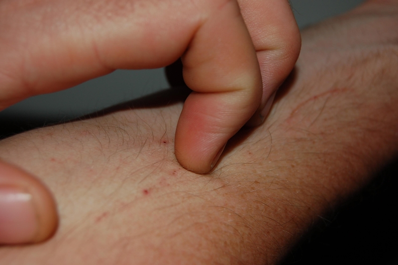 La psoriasis es una enfermedad inflamatoria y crónica que no sólo afecta a la piel. (Especial)