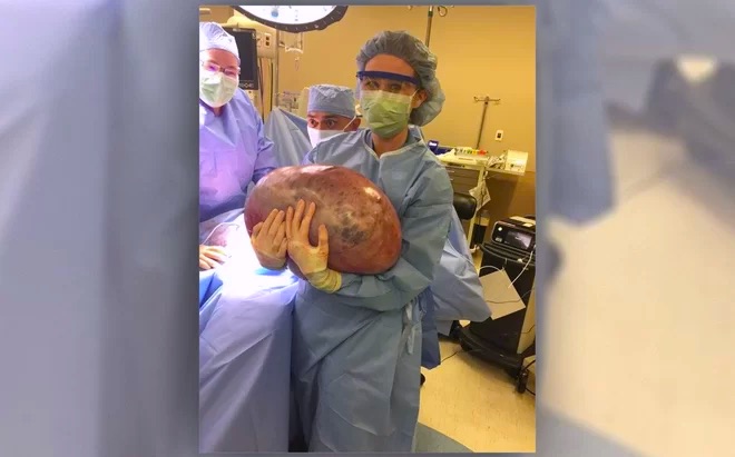 Cirujana posando con el enorme tumor de ovario de 23 kilogramos. (Jackson Hospital)