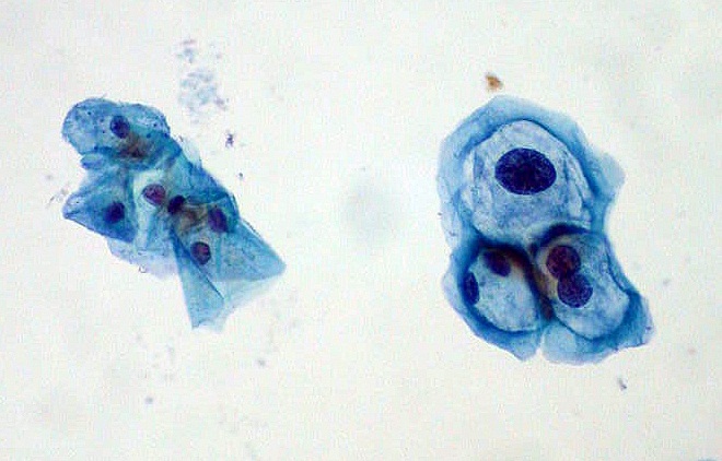 El examen se ha asociado con una mayor detección de lesiones precancerosas, en comparación con el examen de Papanicolaou. (Flickr / Ed Uthman / Europa