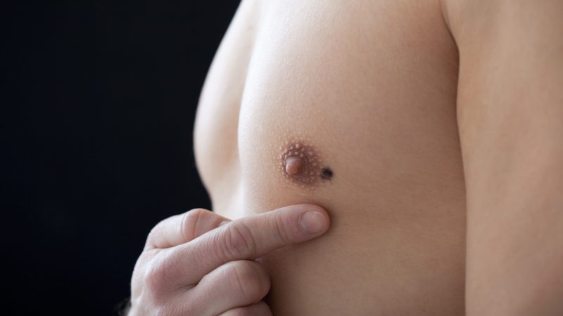 Cáncer de mama en hombres (Especial)