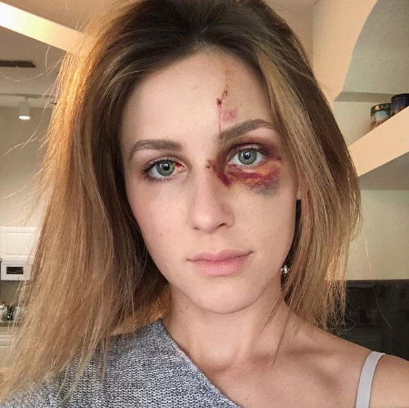 Melissa Gentz muestra su rostro tras la golpiza que recibió de su ex novio (Instagram @melissalgentz)