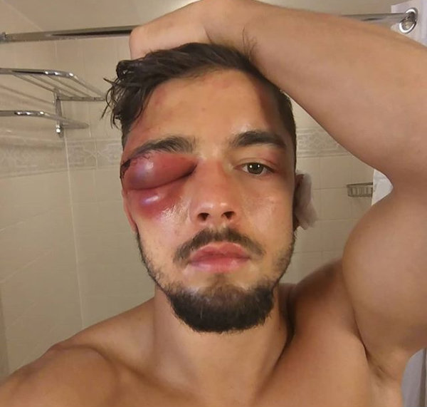 El boxeador Anthony Yigit sufrió una lesión en su ojo izquierdo durante una pelea (Instagram @digityigit)