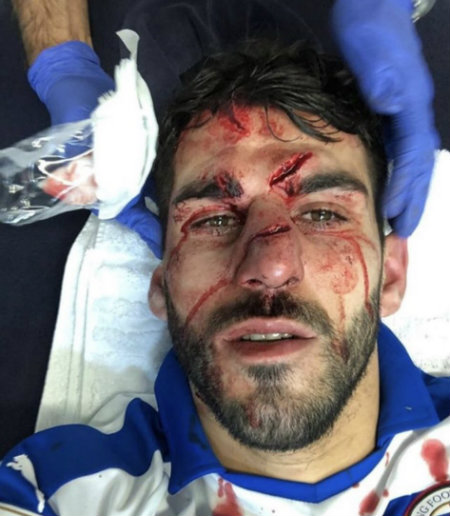Así quedó la cara de Nelson Oliveira tras recibir un pisotón (Twitter)