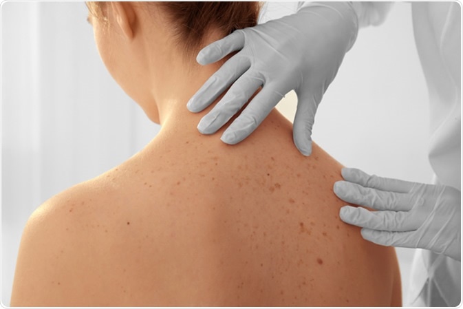 Es importante prestar atención a los lunares para descartar riesgo de cáncer. (Shutterstock)
