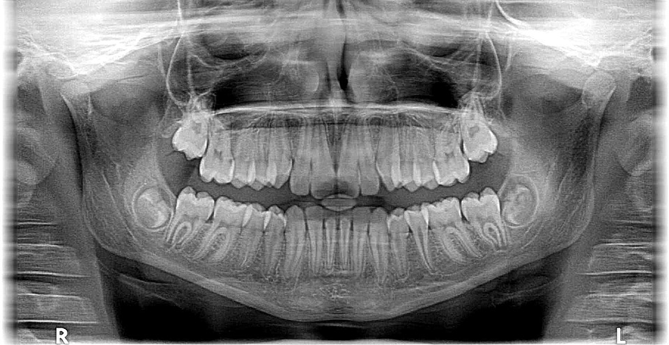 La gingivitis puede causar Alzheimer. (Especial)
