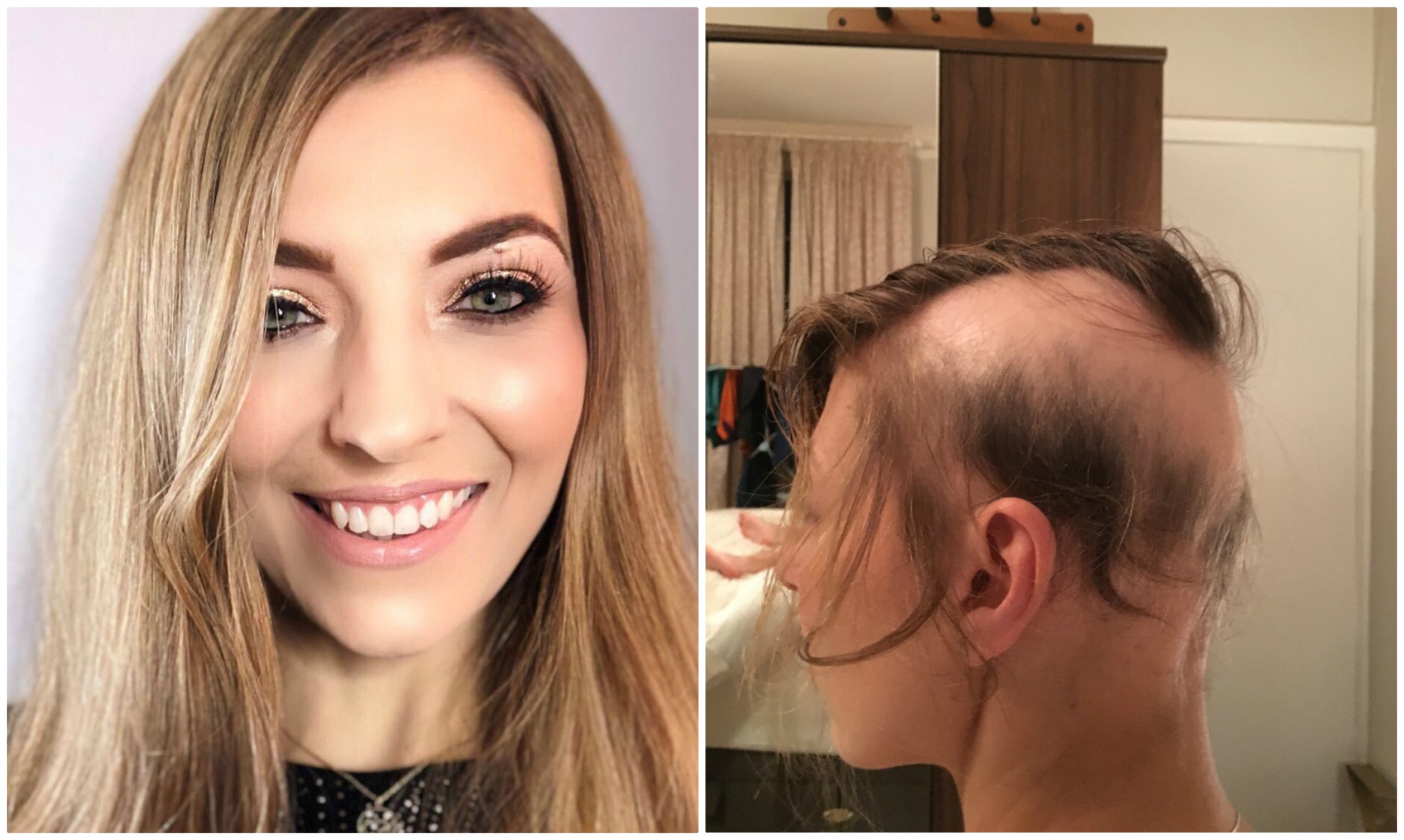 Novia pierde su cabello por estrés (Blog de Michelle Wilson-Stimson).