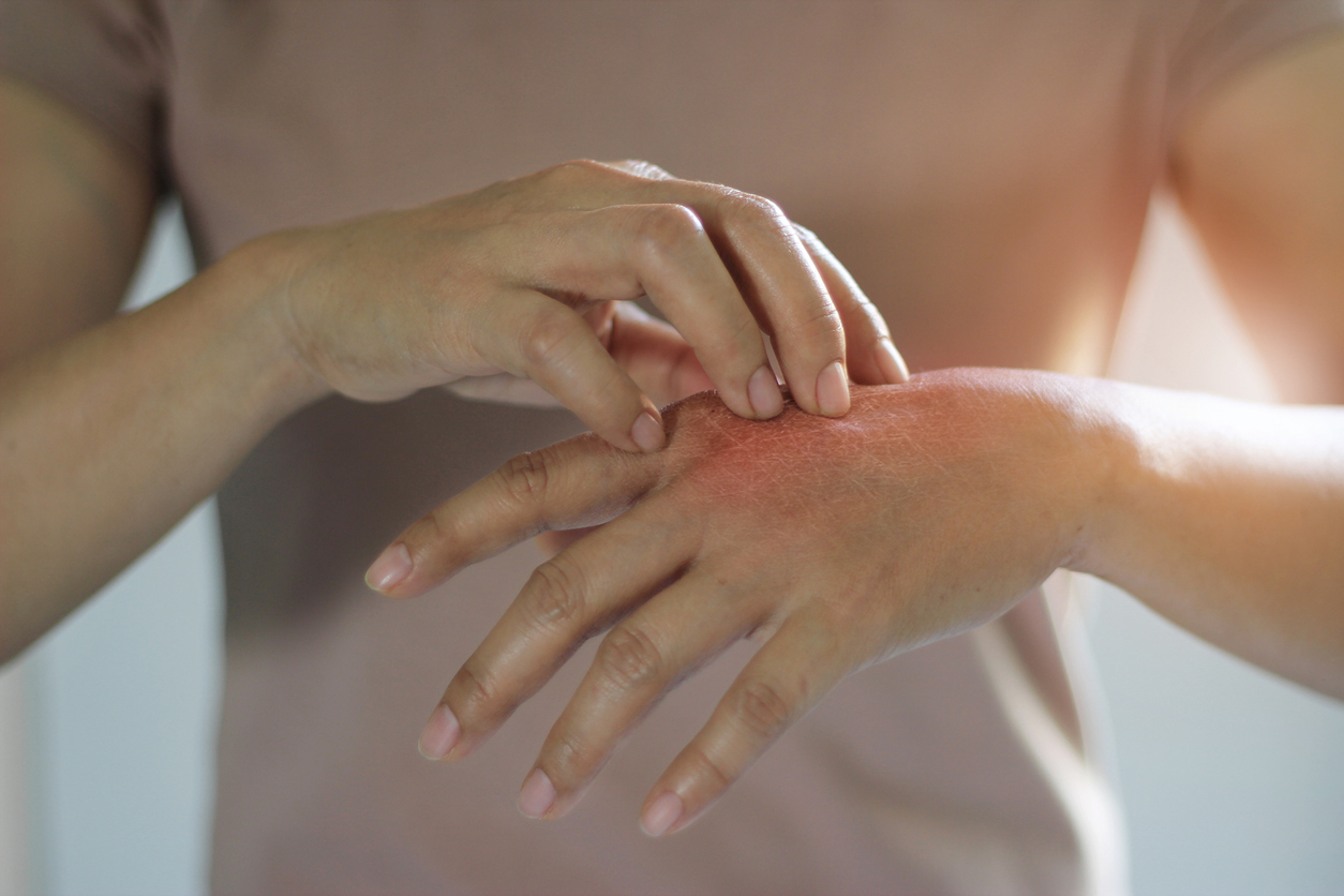 Culebrilla, el virus que se activa con el estrés y causa salpullido (Especial).