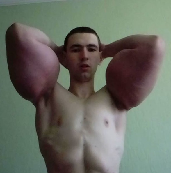 Kirill Tereshin  se inyecta litros de aceite en sus brazos (Instagram @kirilltereshin96)