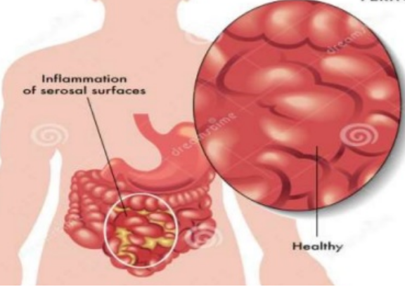 En el caso de la sepsis abdominal, las causas más frecuentes son problemas del sistema digestivo (peritonitis, perforaciones del tubo digestivo) y ves