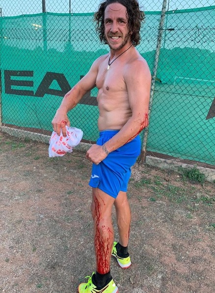Carles Puyol tras su accidente jugando padel (Instagram: @carles5puyol)