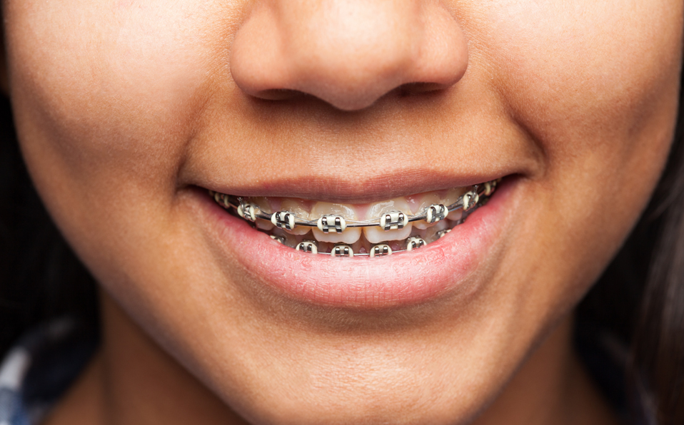 Una realidad es que se pueden usar brackets más de una vez. (Cortesía Freepik)