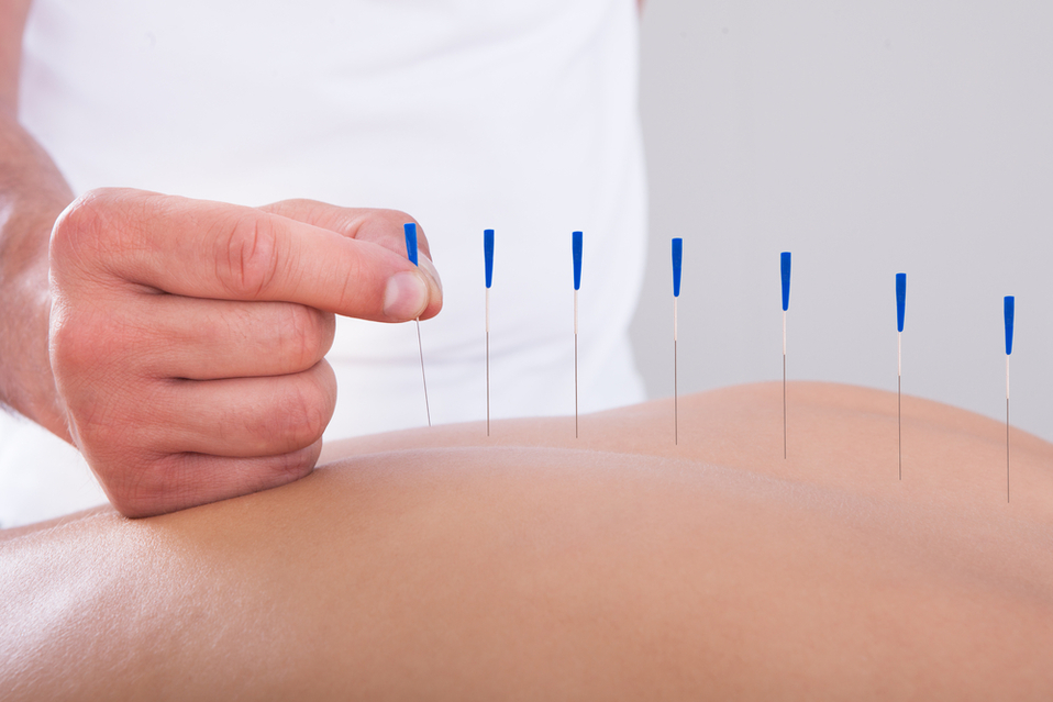 Torreón: dónde puedes aprovechar acupuntura de Salud Pública. (Shutterstock)