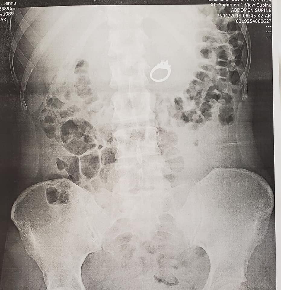 Mujer se traga su anillo de compromiso por una pesadilla (Facebook).