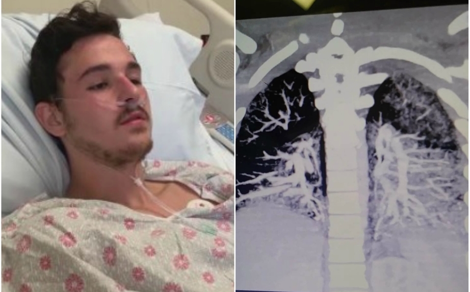 Joven termina con pulmones llenos de aceite solidificado por vapear- Grupo  Milenio