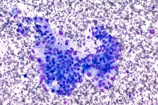 El tratamiento frena la mutación del gen causante del cáncer de páncreas. (El Mundo MX)