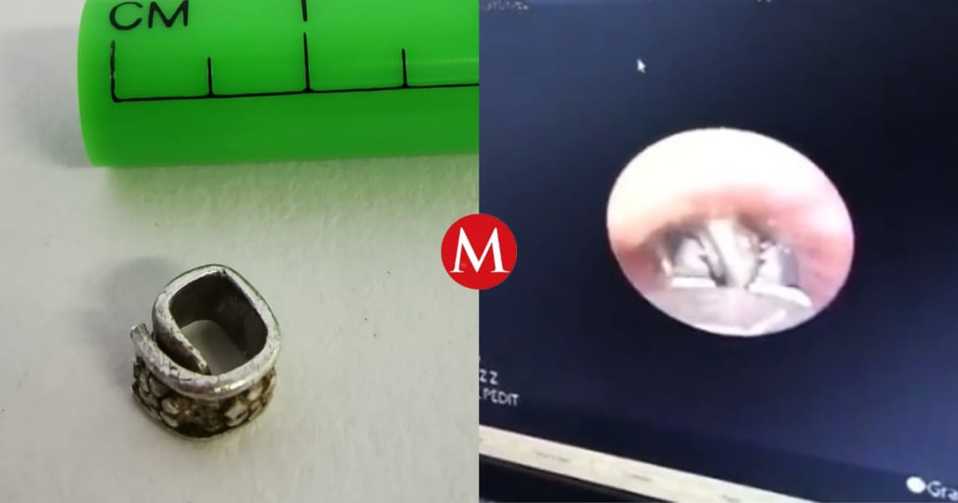Un niño se tragó un anillo y médicos los sustrajeron con el uso de un broncoscopio rígido. Especial.