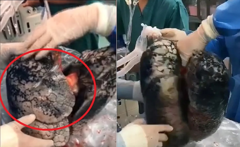 Así quedan los pulmones después de fumar cigarro. (Captura de Pantalla)