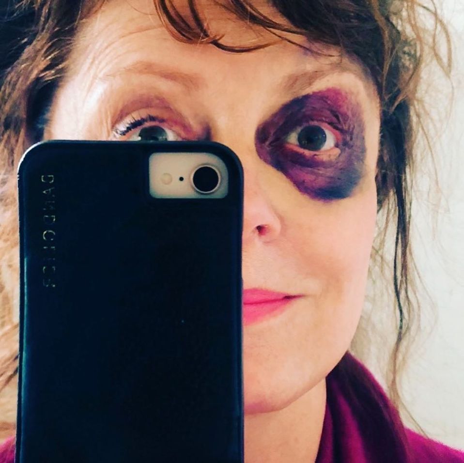 Susan Sarandon se lesiona gravemente el rostro en accidente (Instagram).