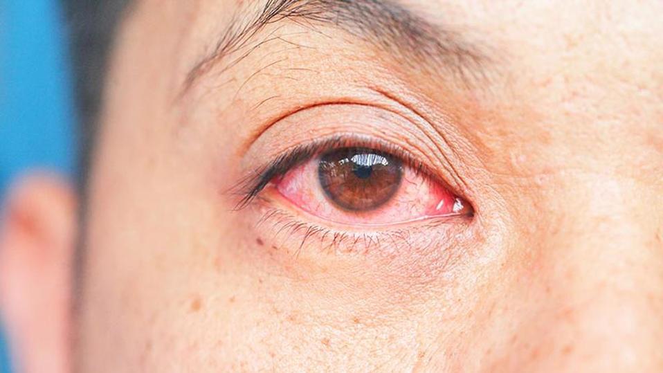 La conjuntivitis es una inflamación de la membrana transporte que recubre al ojo y los párpados (tomada del Twitter @imssjalcontigo).