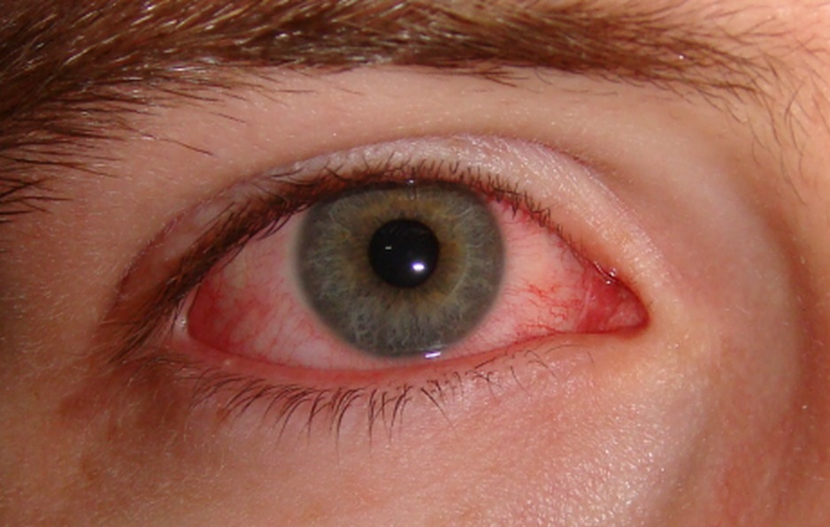 Los ojos rojos es uno de los principales síntomas. (ESPECIAL)