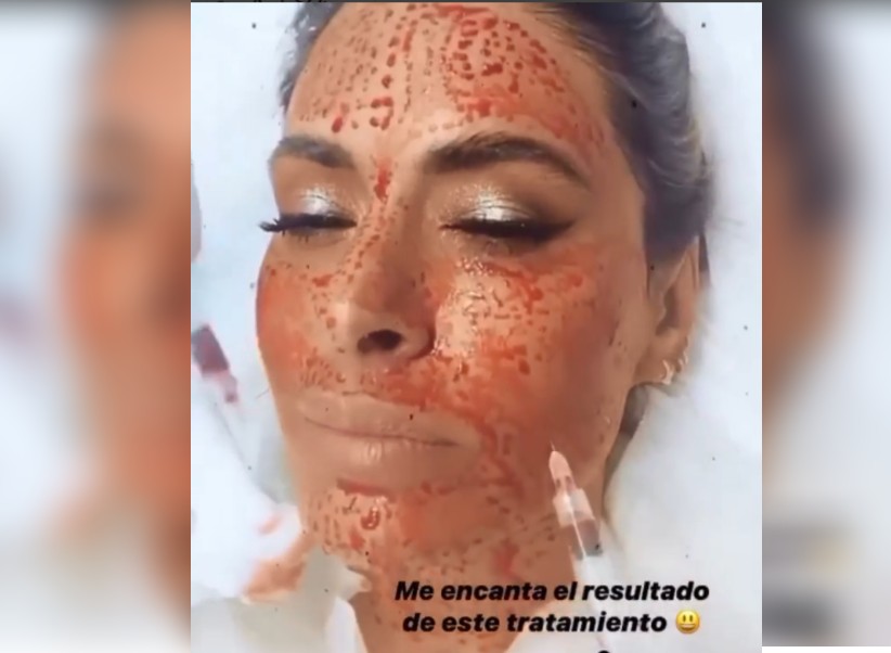 Galilea Montijio se somete a tratamiento de belleza con sangre (Instagram).