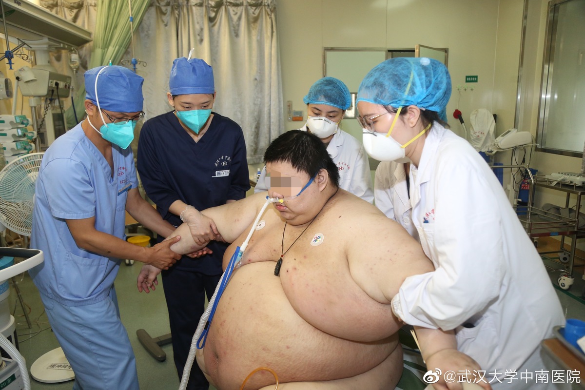 Zhou fue considerado uno de los hombres más obesos de China. (Hospital Central Sur de la Universidad de Wuhan, Weibo)