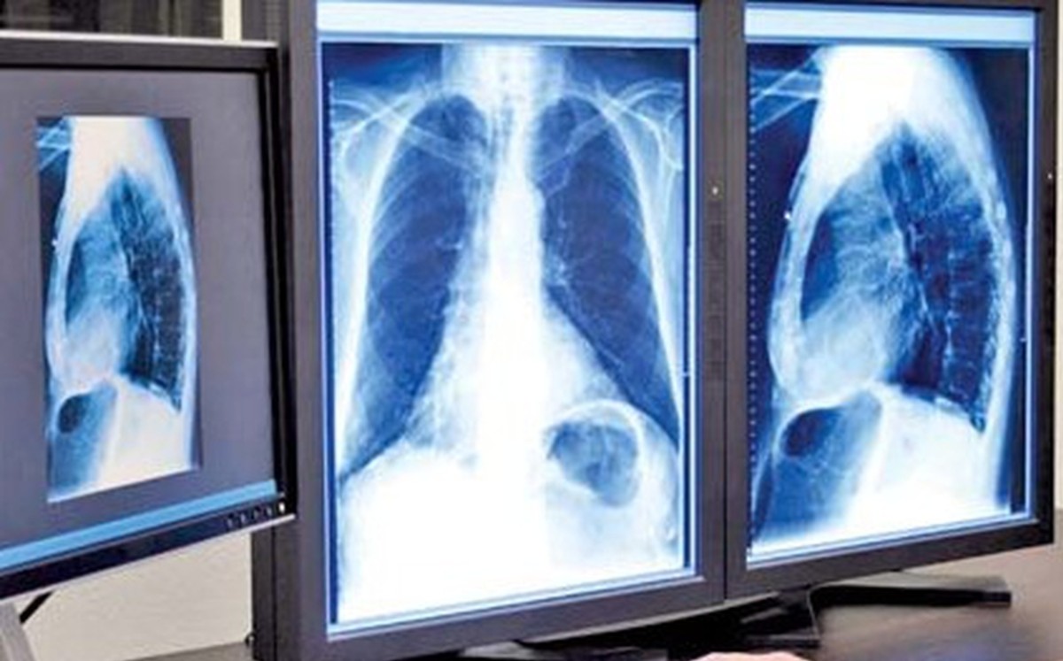En Monterrey, realizan trasplante de pulmones a hombre que superó el covid